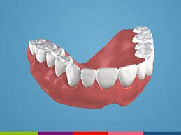 Ihr nutzen eine cover denture prothese ist an den natürlichen restzähnen befestigt und ist dadurch in ihrer lage stabil gesichert. Straumann Cares Denture Digitale Zahnprothese