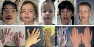 In 1951, the londonphysician richard asher recognized this strangemental disorder in some of his patients, andtherefore decided to pay homage to this veryendearing personage. Bainbridge Ropers Syndrome Caused By Loss Of Function Variants In Asxl3 A Recognizable Condition European Journal Of Human Genetics