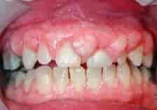 Grunnet ocd har jeg som tvangshandling å bite i tannkjøttet. Munnhulesykdommer Store Medisinske Leksikon