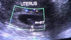 Learn flicker in english translation and other related translations from khmer to english. Cardiac Flicker In Early Pregnancy By Doppler Youtube