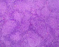 Image result for Lymphoma