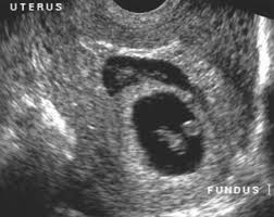 Maybe you would like to learn more about one of these? First Trimester Pregnancy Chapter 9 Ultrasound In Assisted Reproduction And Early Pregnancy