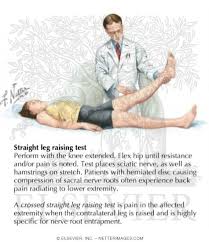 Image result for Crossed-Leg Test