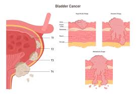 Image result for Bladder Cancer