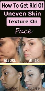 This makes the texture of the skin in those areas different and uneven. How To Get Rid Of Uneven Skin Texture On Face Smooth Skin Face Uneven Skin Dry Skin On Face