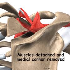 Image result for Snapping Scapula