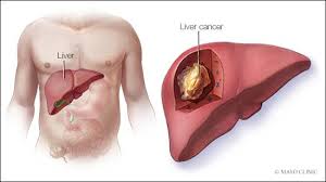 Liver cancer (also known as hepatic cancer, primary hepatic cancer, or primary hepatic malignancy) is cancer that starts in the liver. Prolonged Jaundice Sign Of Liver Cancer Paediatrician Maritime First Newspaper