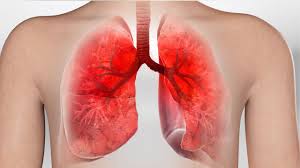 Image result for Acute Bronchitis