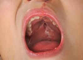 El labio leporino (fisura labial) y el paladar hendido (fisura palatina) son anomalías congénitas que afectan a los tejidos del labio superior y del. Paladar Hendido En Ninos Todo Lo Que Debes Saber Eres Mama