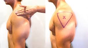 In this video, we cover how to locate the correct site for giving an intramuscular injection to the deltoid. 18 6 Administering Intramuscular Medications Nursing Skills
