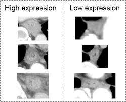 Browse the user profile and get inspired. Radiogenomics Predicts The Expression Of Microrna 1246 In The Serum Of Esophageal Cancer Patients Scientific Reports