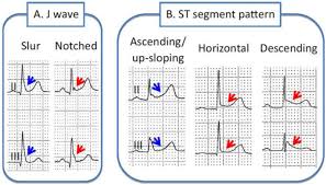 Image result for Early Repolarization