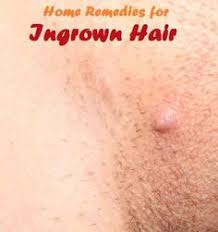 Looking at pictures, an ingrown follicle appears almost similar to a raised red pimple. 46 Ingrown Hair Ideas Ingrown Hair Ingrown Hair Remedies Ingrown Hair Removal