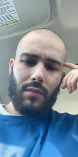 Signs and symptoms of hair loss may include: 20 Years Old Been Dealing With Hair Thinning For About Two Years Now Been About A Year Or So Since I Started Buzzing My Head But I Rarely Don T Have A Hat