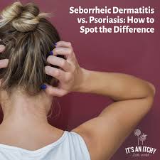 About half of those who have psoriasis also have scalp. Psoriasis Vs Seborrheic Dermatitis What S The Difference