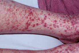 The condition refers to a problem in which purple spots appear on the skin. Henoch Schonlein Purpura Causes Symptoms Prognosis Treatment