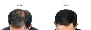 More so, after making the incisions, the skin becomes tightened, and this can cause the hairline itself to push back. When Do The Hair Grow Back After A Hair Transplant