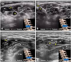 Image result for Superior Trunk Block