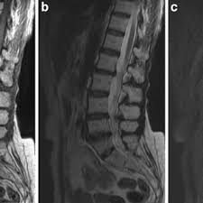 Human skeleton with each bone name Pdf Hyperintense Vertebral Lesions