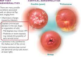 Tiny changes begin in epithelial cells. Cervical Dysplasia And Cancer Symptoms Causes And Treatments Cigc