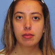 Case Report of Idiopathic Masseteric Hypoplasia Treated With Polymethyl  Methacrylate-Collagen Gel