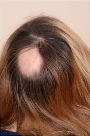 So it never appears, as a term, on its own. Hair Camouflage A Comprehensive Review Sciencedirect