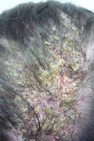 Image result for Pemphigus