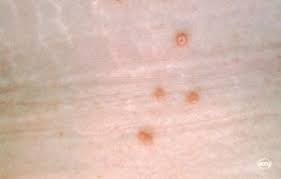 Molluscum contagiosum (mc), also known as water warts, is an infectious skin condition that results in groupings of small bumps or lesions on the upper layers of the skin. Water Warts What Is Molluscum Contagiosm And How Is It Treated