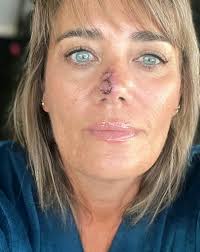 Image result for skin cancer on nose pimple
