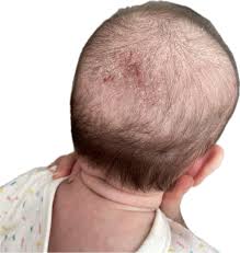 Image result for Cradle Cap