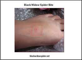 Some people may notice minor stinging such as that felt with a bee sting when bitten by the spider. Black Widow Bite Symptoms Picture Latrodectus Bite Treatment