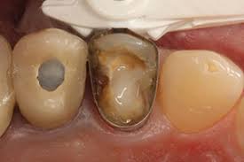 Dec 16, 2017 · the increment in fiber content and length of fiber caused increment in optimum moisture content (omc) and slight decrement of maximum dry density (mdd). An Efficient And Reliable Post And Core Technique Dentistry Today