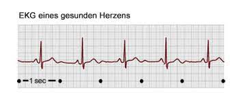 Eine herzbeutelentzündung wird als perikarditis bezeichnet. Bradykardien Wenn Das Herz Zu Langsam Schlagt