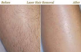 Laser hair removal is one increasingly popular treatment option for men and women alike to reduce continue reading. Laser Hair Removal Minneapolis Mn