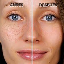 824581013010025879 Face Mapping Acne Acne Treatment Beauty Skin Care Routine