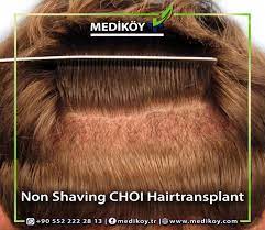 Check out the instructions given below that will tell you how to sew in a hair weave. Female Hair Transplant Be Done Without Shaving The Heir
