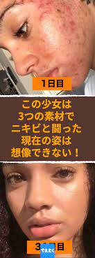 この少女は 3つの素材でニキビと闘った 現在の姿は想像できない シンプル 即効 自作のニキビケア習慣を2ヶ月続けた女性の現在の姿がすごい スキンケア ニキビ 対策 フェイスマスク 洗顔 ニキビ跡 ホホバオイル 美容 シンプル スキンケア ニキビ ニキビケア