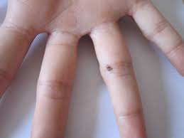 2) el significado del apellido del pulgar. Lunares En Pies Y Manos Doctora Lorea Bagazgoitia Dermatologia