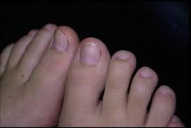 Image result for Koilonychia feet