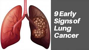 Lung cancer, also known as lung carcinoma, is a malignant lung tumor characterized by uncontrolled cell growth in tissues of the lung. 9 Early Signs Of Lung Cancer Boxym Com