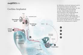 Aktuelles Behandlung Von Tinnitus Endlich Wieder Ruhe Im Ohr Ihr Horgerat De