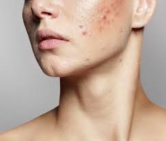 Image result for acne face