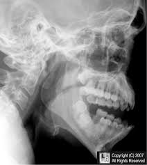 Image result for Jaw Dislocation