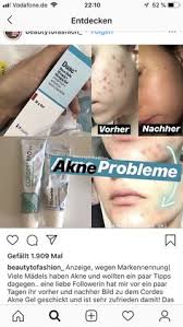 Clindamycine, un antibiotique qui élimine les bactéries et benzoylperoxide, une substance qui ralentit la création de la couche supérieure de la peau la rendant en même temps plus souple. 180 Beauty Ideen Akne Narben Entfernen Schminke Fur Die Hochzeit Akne Gel