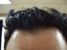 First Signs Of Hair Thinning
