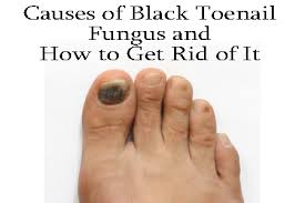 Causes Of Black Toenail Fungus And How To Get Rid Of It Toe Nail Fungus Treatment Black Toenail Fungus Toenail Fungus Toenail Fungus Remedies