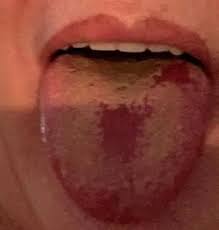 The sooner any possible tumor is detected, the better the outlook. Nhs Urged To Recognise Covid Tongue As Official Sign Of The Disease Daily Mail Online