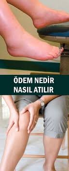 Odem Nedir Saglik Saglik Egitimi Saglik Ve Fitness