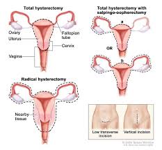 In human anatomy, the groin (the adjective is inguinal, as in inguinal canal) is the junctional area (also known as the inguinal region) between the abdomen and the thigh on either side of the pubic bone. Hysterectomy Image Details Nci Visuals Online