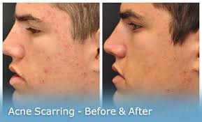 May 14, 2019 · the cost of laser treatment for scars varies. Fraxel For Acne Scars San Diego Ca La Jolla Fraxel